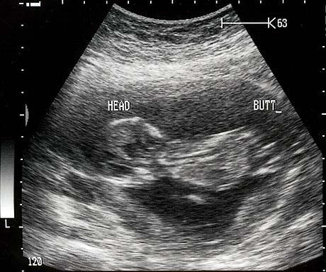 Baby Sonogram Pictures on To Baby Butts  It S A Butt  Not A Fundament Or Other Euphemism